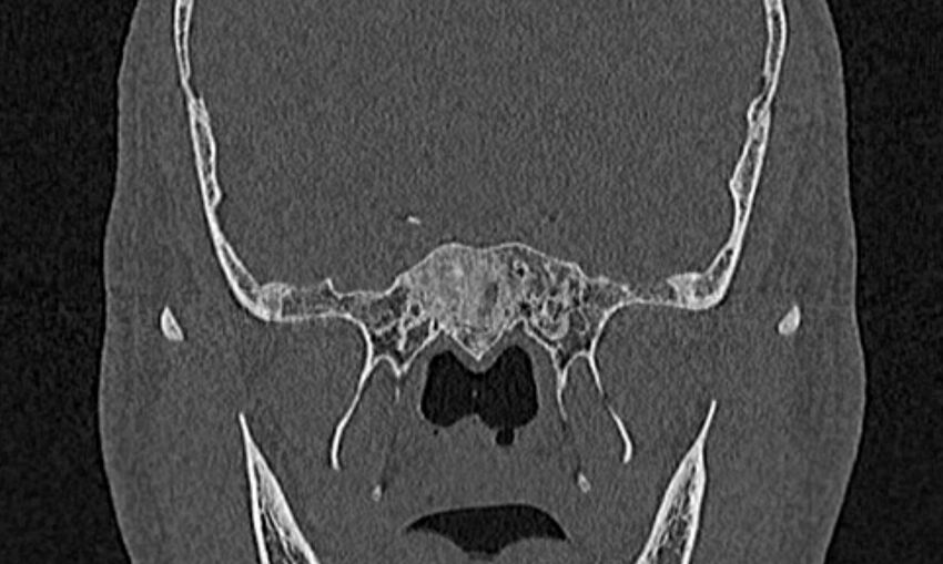 Chronic rhinosinusitis (Radiopaedia 65079-74075 Coronal bone window 74).jpg