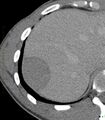 Chronic subcapsular hepatic hematoma (Radiopaedia 29548-30051 A 1).jpg
