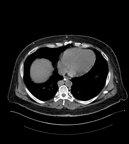 File:Closed-loop small bowel obstruction-internal hernia (Radiopaedia 78439-91096 Axial non-contrast 12).jpg