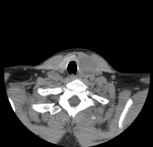 File:Colloid cyst of thyroid (Radiopaedia 22897-22923 Axial non-contrast 43).jpg