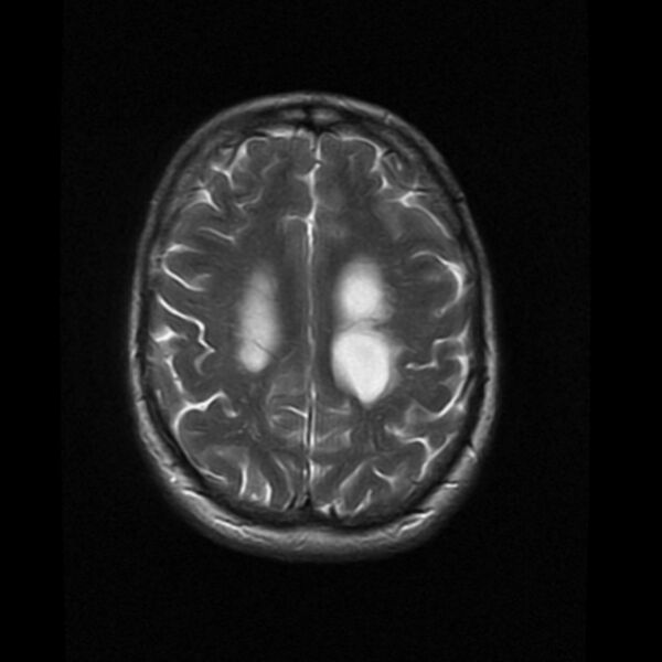 File:Colloid cyst with hydrocephalus (Radiopaedia 9373-10065 Axial T2 15).jpg