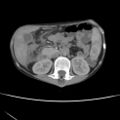 Colocolic fistula - Crohn disease (Radiopaedia 57063-63955 A 30).jpg