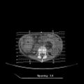 Colocolic fistula - Crohn disease (Radiopaedia 57063-63955 B 1).jpg