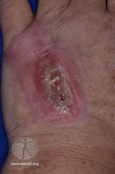 File:Dermatitis artefacta (DermNet NZ dermatitis-d-a2).jpg