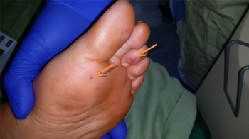 Janeway lesions (arrows) on the toes and sole, seen in a patient with massive aortic valve vegetation.