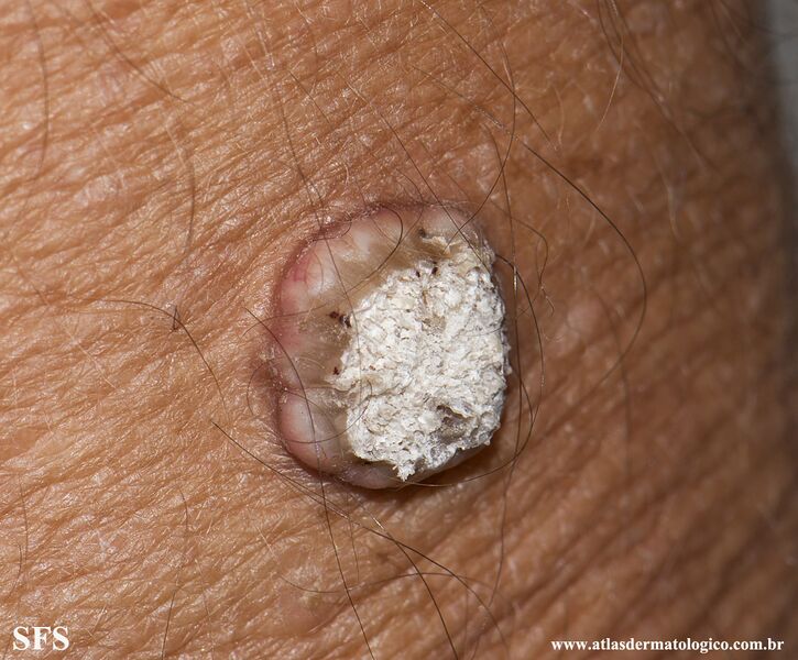 File:Keratoacanthoma (Dermatology Atlas 71).jpg