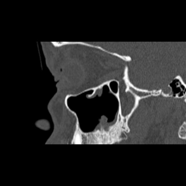 File:Nasal septal perforation (Radiopaedia 25030-25289 Sagittal bone window 2).jpg