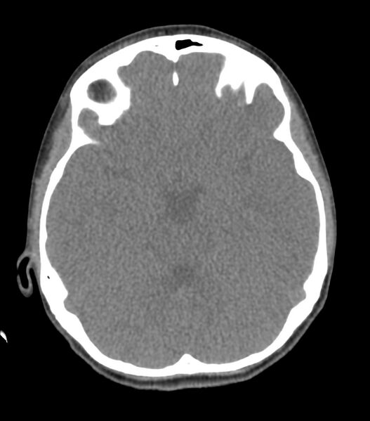 File:Nasoorbitoethmoid fracture (Radiopaedia 90044-107205 Axial non-contrast 185).jpg