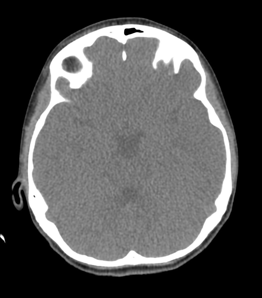 Nasoorbitoethmoid fracture (Radiopaedia 90044-107205 Axial non-contrast 185).jpg