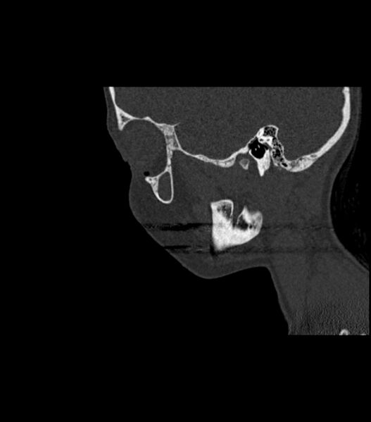 File:Nasoorbitoethmoid fracture (Radiopaedia 90044-107205 Sagittal bone window 110).jpg