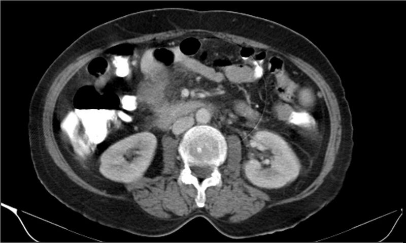 File:Necrotizing pancreatitis (Radiopaedia 20595-20495 A 20).jpg