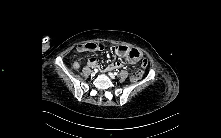 Neo-terminal ileal stricture (Crohn disease) (Radiopaedia 33790-34948 A 321).jpg