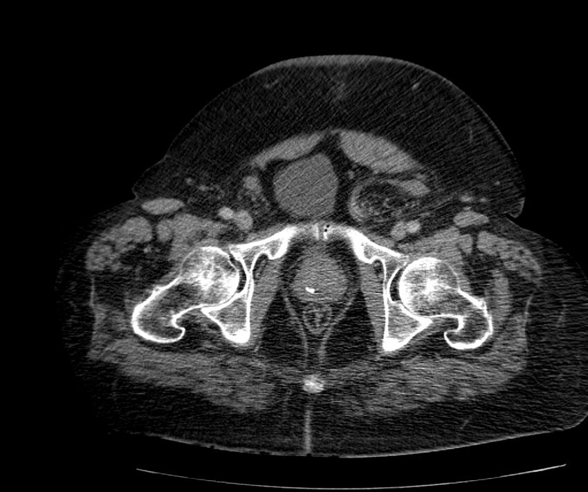 Nephroptosis with inguinal hernia containing perirenal fat (Radiopaedia 56632-63391 C 320).jpg