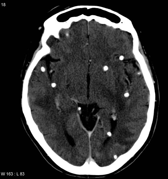 File:Neurocysticercosis (Radiopaedia 7773-8596 C+ delayed 6).jpg
