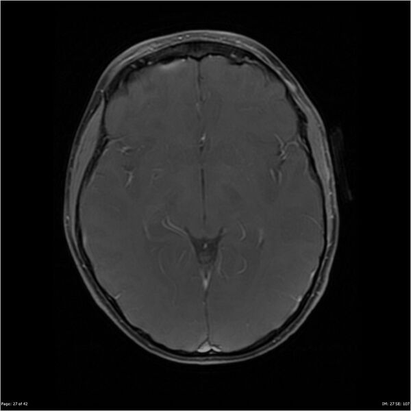 File:Neurofibromatosis type 1 (Radiopaedia 22541-22564 Axial T1 C+ fat sat 27).jpg