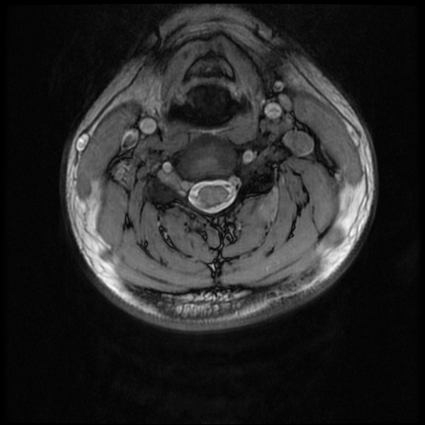 File:Neurofibromatosis type 2 (Radiopaedia 44936-48837 Axial Gradient Echo 23).png