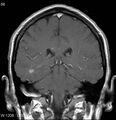 Neurosarcoidosis (Radiopaedia 10930-17204 Coronal T1 C+ 12).jpg