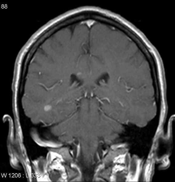 File:Neurosarcoidosis (Radiopaedia 10930-17204 Coronal T1 C+ 12).jpg