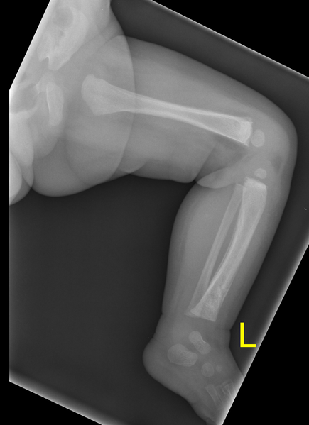File:Non-accidental injury (Radiopaedia 32878-33854 Lateral 1).png