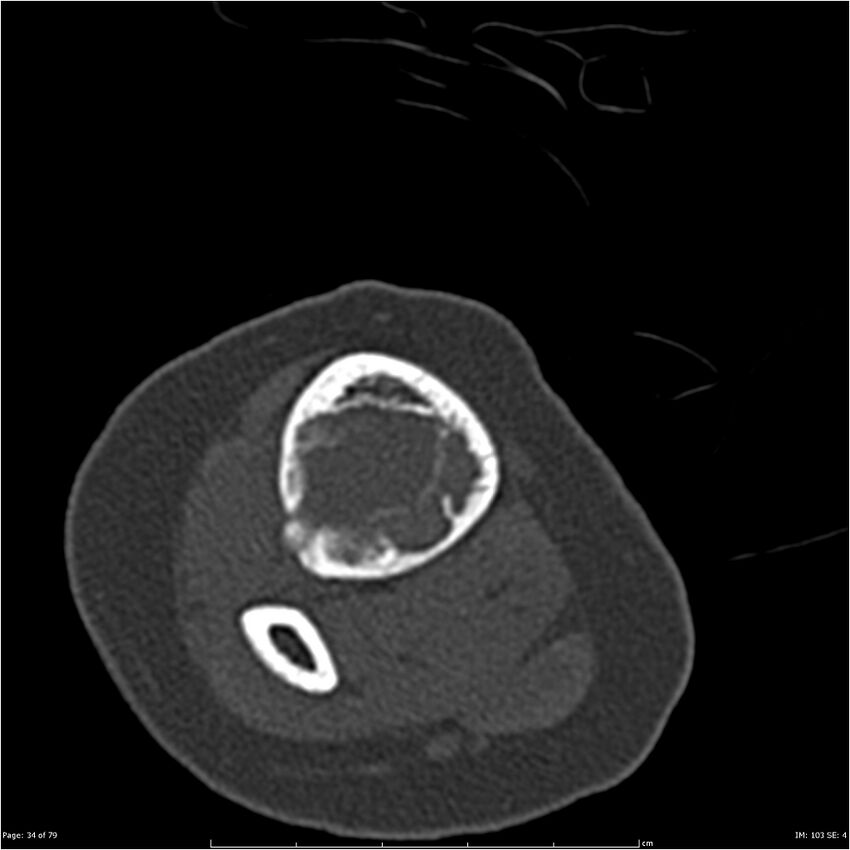 Non-ossifying fibroma (Radiopaedia 23651-23780 bone window 34).jpg