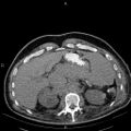 Non Hodgkin lymphoma in a patient with ankylosing spondylitis (Radiopaedia 84323-99621 Axial non-contrast 31).jpg