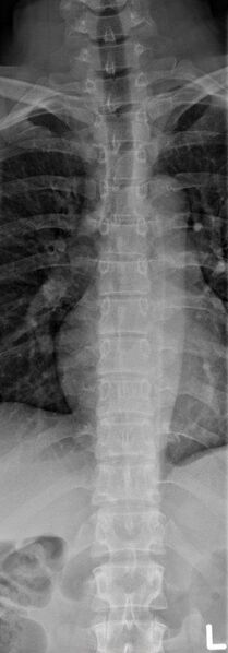File:Normal AP thoracic spine radiograph (Radiopaedia 46581).jpg