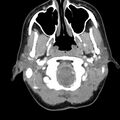 Normal CT of the neck (Radiopaedia 14575-14500 Axial C+ 18).jpg