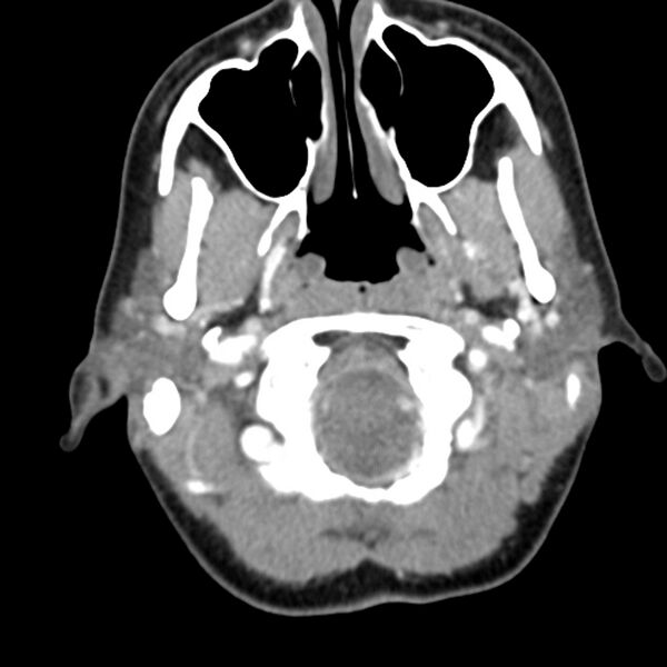 File:Normal CT of the neck (Radiopaedia 14575-14500 Axial C+ 18).jpg