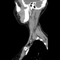 Normal CT of the neck (Radiopaedia 14575-14500 Sagittal C+ 12).jpg