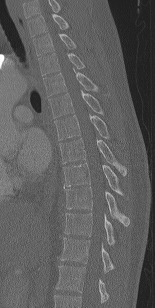 File:Normal CT thoracic spine (Radiopaedia 40181-42688 Sagittal bone window 32).png