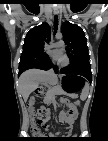 File:Normal CT virtual gastroscopy (Radiopaedia 29960-30501 E 9).jpg
