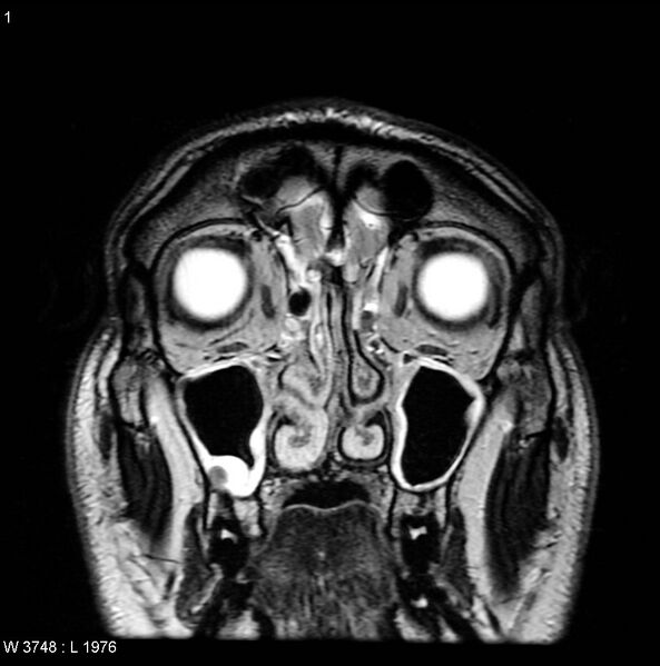 File:Normal coronal brain (Radiopaedia 6676-7910 Coronal T2 1).jpg