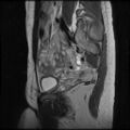 Normal female pelvis MRI (retroverted uterus) (Radiopaedia 61832-69933 Sagittal T2 10).jpg