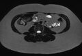 Normal liver MRI with Gadolinium (Radiopaedia 58913-66163 E 2).jpg