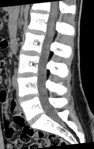 File:Normal lumbar spine CT (Radiopaedia 46533-50986 C 53).png