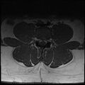 Normal lumbar spine MRI (Radiopaedia 47857-52609 Axial T1 14).jpg