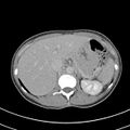 Normal multiphase CT liver (Radiopaedia 38026-39996 Axial C+ delayed 20).jpg