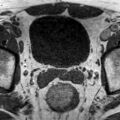 Normal prostate (MRI) (Radiopaedia 29986-30535 Axial T1 21).jpg