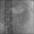 Normal superior mesenteric artery angiogram (Radiopaedia 77416).jpg