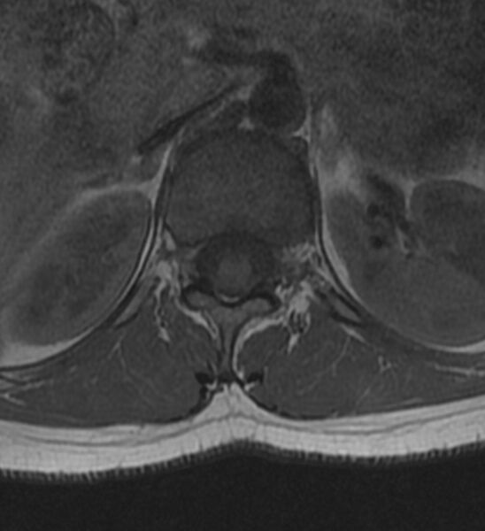 File:Normal thoracic spine MRI (Radiopaedia 41033-43781 Axial T1 31).jpg