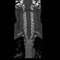 Occipital condyle fracture (Radiopaedia 31755-32691 Coronal bone window 18).jpg
