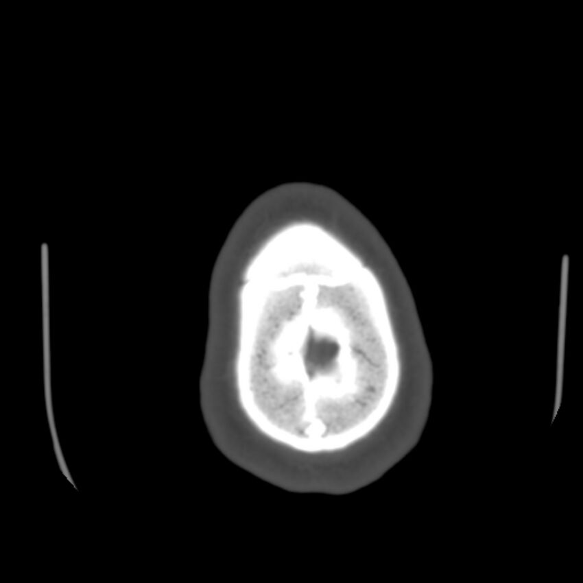 Occipital spur - asymptomatic (Radiopaedia 87753-104201 Axial bone window 207).jpg