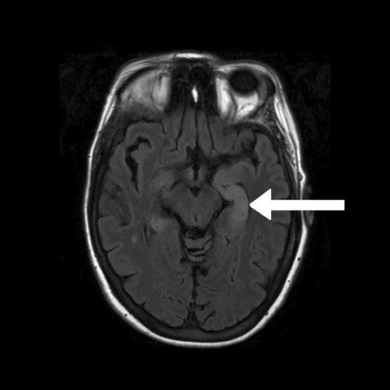FLAIR MRI-Indicates bright signal from medial temporal lobe consistent with limbic encephalitis arrow