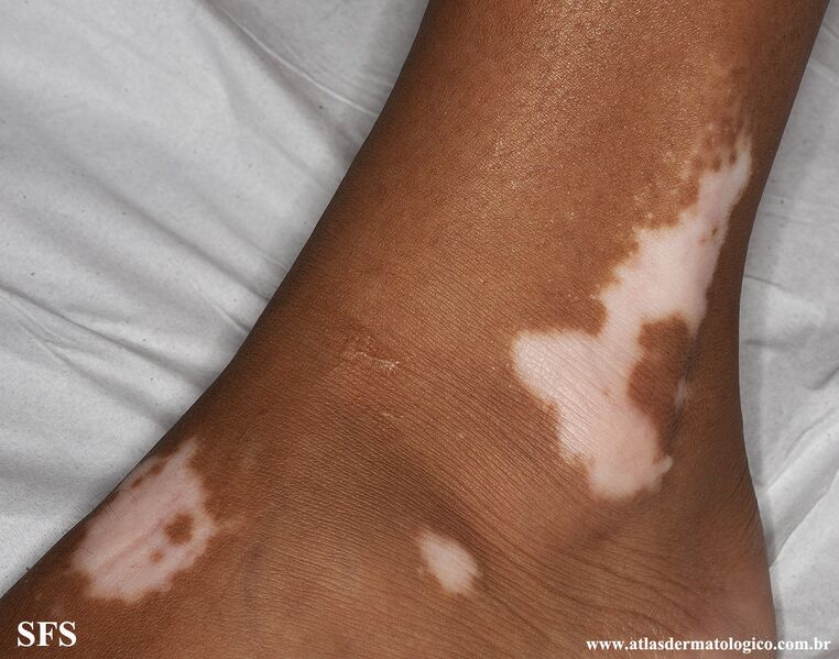 File:Vitiligo (Dermatology Atlas 50).jpg