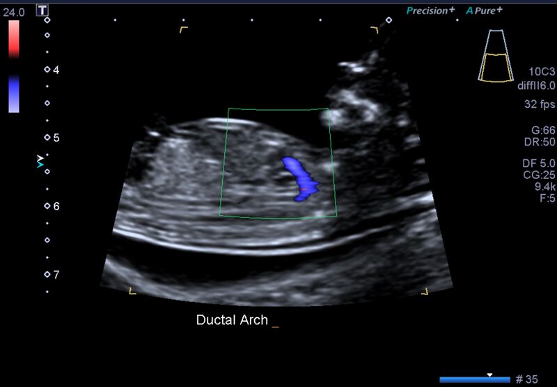 File:1st trimester nuchal-morphology ultrasound (Radiopaedia 44706-48477 General anatomy and NT 25).jpg