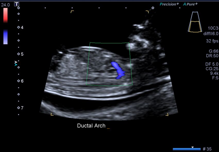 1st trimester nuchal-morphology ultrasound (Radiopaedia 44706-48477 General anatomy and NT 25).jpg