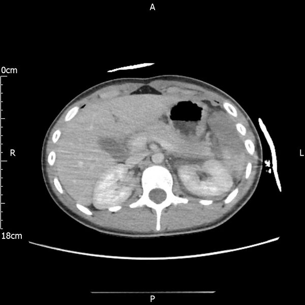File:AAST grade IV kidney injury with CEUS follow-up (Radiopaedia 72353-82877 Axial C+ portal venous phase 20).jpg