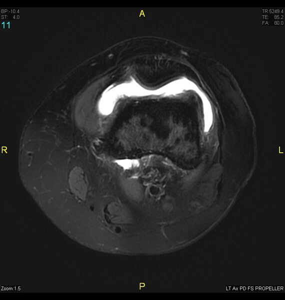 File:ACL mucoid degeration with cystic changes (Radiopaedia 48428-53341 Axial PD fat sat 8).jpg