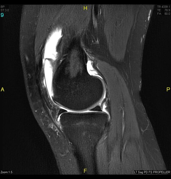 File:ACL mucoid degeration with cystic changes (Radiopaedia 48428-53341 Sagittal PD fat sat 7).jpg