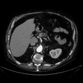 Abdominal aortic aneurysm (Radiopaedia 25855-26001 Axial C+ arterial phase 41).jpg